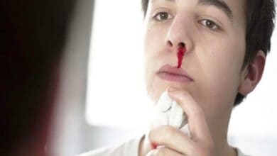 Chảy máu mũi - nguyên nhân, nguy hiểm và cách xử lý