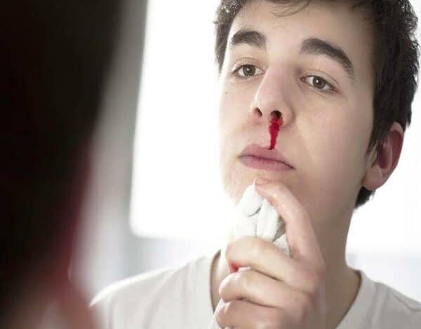 Chảy máu mũi - nguyên nhân, nguy hiểm và cách xử lý