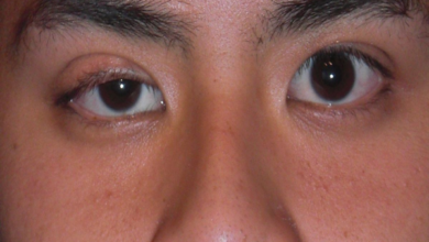 Bị sụp mí mắt phải làm sao? Nguyên nhân và cách điều trị